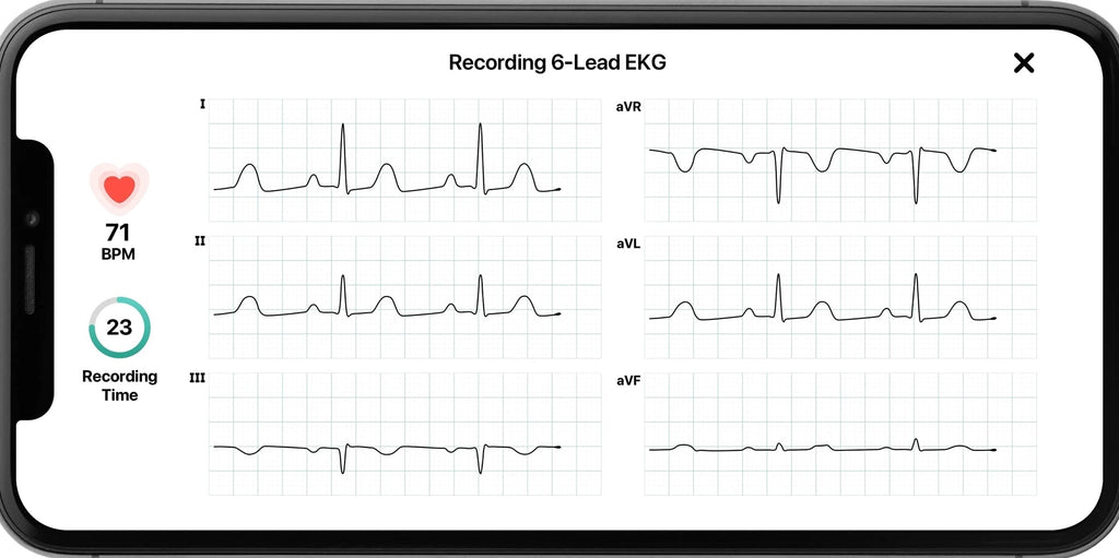 KardiaMobile 6L Personal EKG Monitor with Most Smartphones